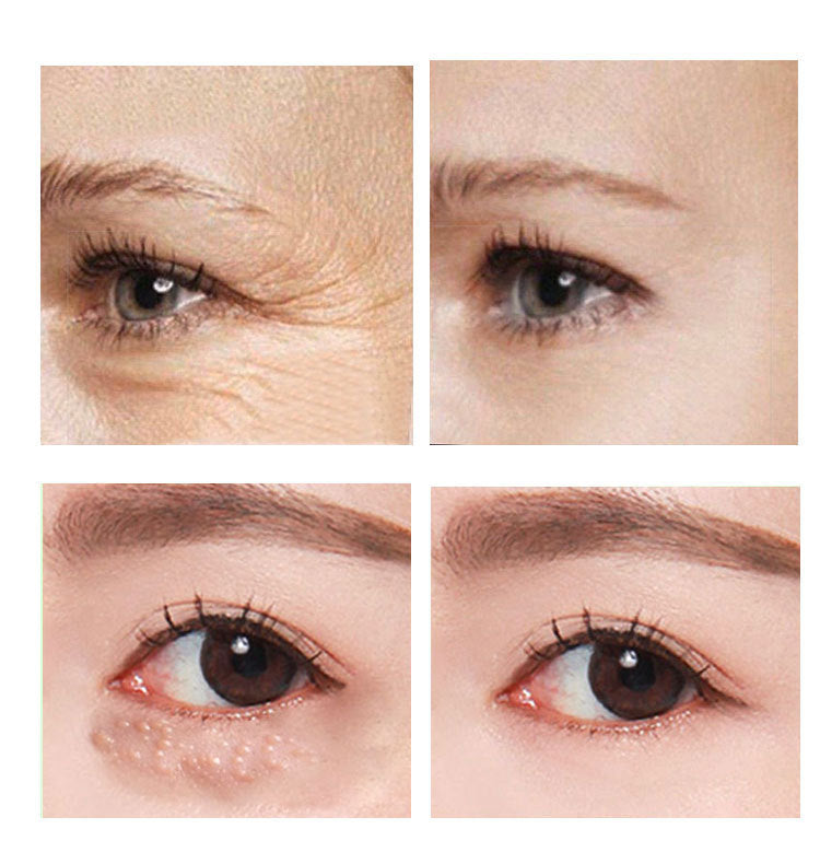 Best eye cream for dark circles clinique eye cream